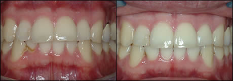 Invisalign case 2, crowding – before (left) and after (right), front view of the bite